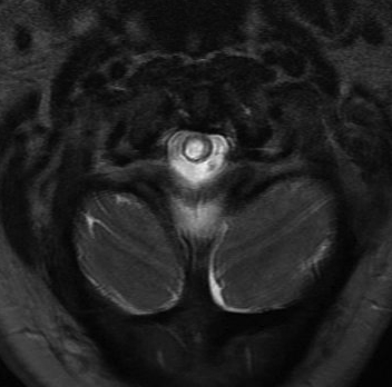 Cervicomedullary Syrinx 2